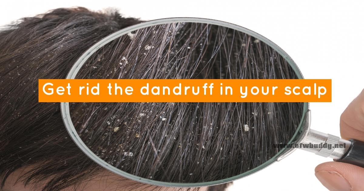 How to get rid of dandruff? - OFW Buddy